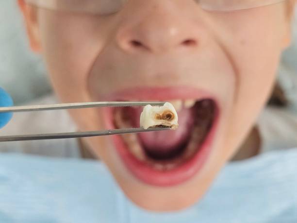Best Urgent Care for Lost Fillings or Crowns in Germantown, WI