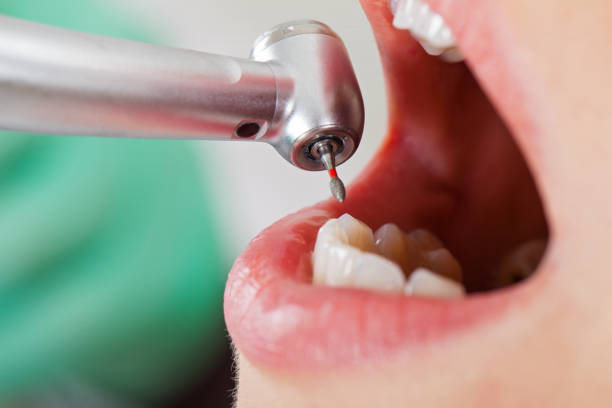 Best Urgent Care for Lost Fillings or Crowns in Germantown, WI